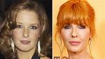 Beth Dutton Lip Injections: Surgery Before and After Photos