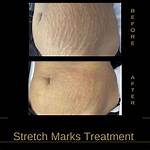 Celebrating Beauty: Bbw with Stretch Marks