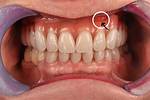 Day 3 After Immediate Dentures: Unlocking Comfort and Confidence