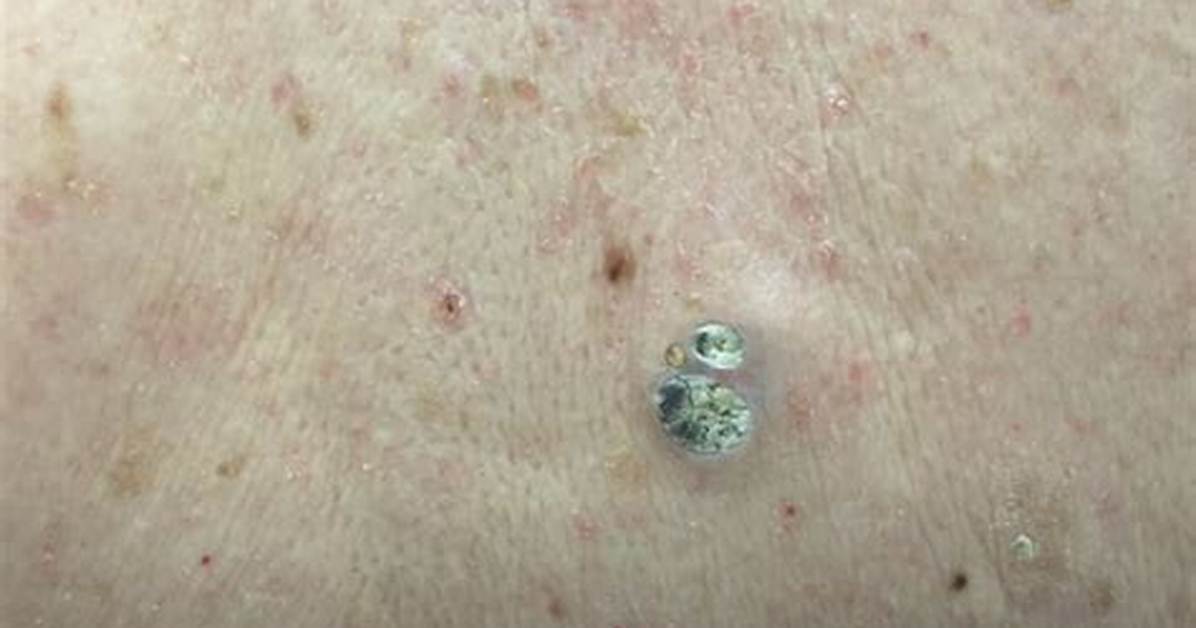 Dr Pimple Popper: Pore of Winer Extraction Explored What Is Tlc Shows Biggest Blackhead?