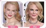 Explore Nicole Kidman's Cosmetic Enhancements: a Guide to Her Plastic Surgery Procedures