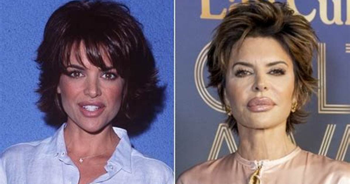 Lisa Rinna's Plastic Surgery Explained |