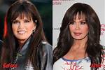 Marie Osmond Facelift and Plastic Surgery Before and After Pics, Age and Height |