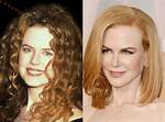 Nicole Kidman: the Evolution of Beauty Through Plastic Surgery Photos