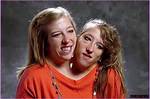 Tragic Loss: Conjoined Twins, Abby and Brittany, Succumb to Pregnancy Complications