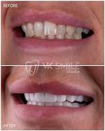 Uncovering the Secrets Behind His Veneers