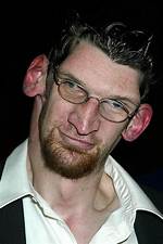 Understanding Matthew Mcgrory's Disease: a Deep Dive into Acromegaly