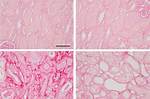 Understanding the Journey of Kidney Transplant Scars